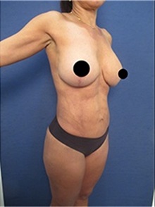Breast Lift After Photo by Arian Mowlavi, MD; Laguna Beach, CA - Case 36533