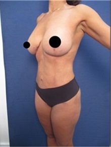 Breast Lift After Photo by Arian Mowlavi, MD; Laguna Beach, CA - Case 36533