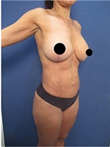 Breast Implant Removal After Photo by Arian Mowlavi, MD; Laguna Beach, CA - Case 36534