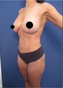 Breast Implant Removal After Photo by Arian Mowlavi, MD; Laguna Beach, CA - Case 36534