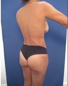 Buttock Lift with Augmentation After Photo by Arian Mowlavi, MD; Laguna Beach, CA - Case 36535