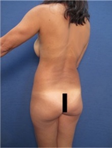Buttock Lift with Augmentation Before Photo by Arian Mowlavi, MD; Laguna Beach, CA - Case 36535