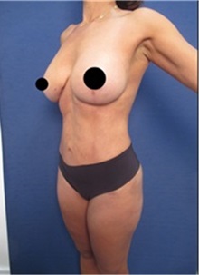 Buttock Lift with Augmentation After Photo by Arian Mowlavi, MD; Laguna Beach, CA - Case 36535