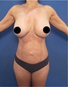 Liposuction After Photo by Arian Mowlavi, MD; Laguna Beach, CA - Case 36536