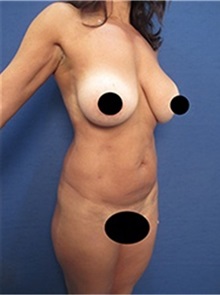 Liposuction Before Photo by Arian Mowlavi, MD; Laguna Beach, CA - Case 36536