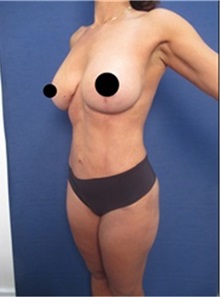 Liposuction After Photo by Arian Mowlavi, MD; Laguna Beach, CA - Case 36536