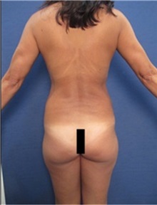 Liposuction Before Photo by Arian Mowlavi, MD; Laguna Beach, CA - Case 36536