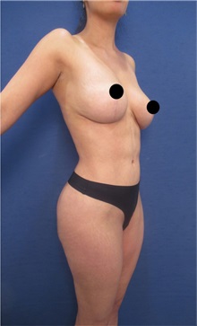 Buttock Lift with Augmentation After Photo by Arian Mowlavi, MD; Laguna Beach, CA - Case 36539
