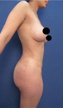 Buttock Lift with Augmentation Before Photo by Arian Mowlavi, MD; Laguna Beach, CA - Case 36539