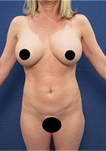 Breast Implant Revision Before Photo by Arian Mowlavi, MD; Laguna Beach, CA - Case 36549