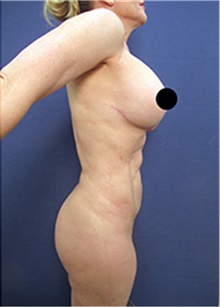Breast Implant Revision After Photo by Arian Mowlavi, MD; Laguna Beach, CA - Case 36549