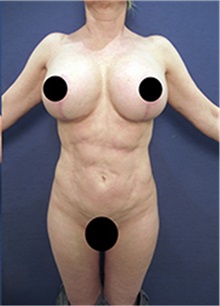 Breast Lift After Photo by Arian Mowlavi, MD; Laguna Beach, CA - Case 36550