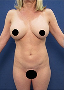 Breast Lift Before Photo by Arian Mowlavi, MD; Laguna Beach, CA - Case 36550