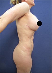 Liposuction After Photo by Arian Mowlavi, MD; Laguna Beach, CA - Case 36551