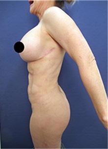 Liposuction After Photo by Arian Mowlavi, MD; Laguna Beach, CA - Case 36551