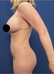 Liposuction Before Photo by Arian Mowlavi, MD; Laguna Beach, CA - Case 36551