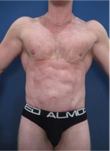 Tummy Tuck After Photo by Arian Mowlavi, MD; Laguna Beach, CA - Case 36561