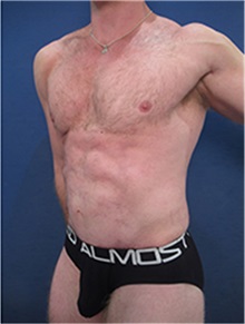 Tummy Tuck After Photo by Arian Mowlavi, MD; Laguna Beach, CA - Case 36561