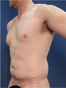 Tummy Tuck Before Photo by Arian Mowlavi, MD; Laguna Beach, CA - Case 36561