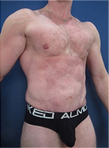 Tummy Tuck After Photo by Arian Mowlavi, MD; Laguna Beach, CA - Case 36561