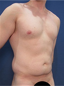 Tummy Tuck Before Photo by Arian Mowlavi, MD; Laguna Beach, CA - Case 36561