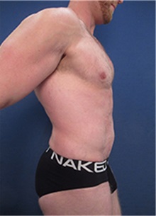 Tummy Tuck After Photo by Arian Mowlavi, MD; Laguna Beach, CA - Case 36561