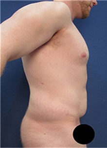 Tummy Tuck Before Photo by Arian Mowlavi, MD; Laguna Beach, CA - Case 36561