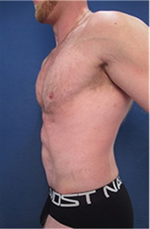 Tummy Tuck After Photo by Arian Mowlavi, MD; Laguna Beach, CA - Case 36561