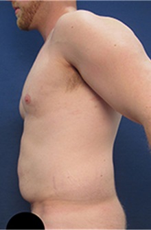 Tummy Tuck Before Photo by Arian Mowlavi, MD; Laguna Beach, CA - Case 36561