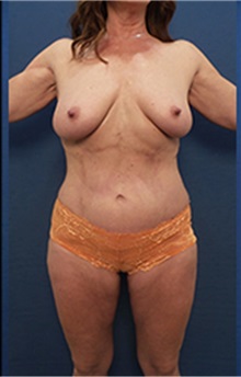 Body Contouring After Photo by Arian Mowlavi, MD; Laguna Beach, CA - Case 36562