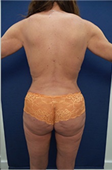 Buttock Lift with Augmentation After Photo by Arian Mowlavi, MD; Laguna Beach, CA - Case 36564