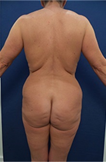 Buttock Lift with Augmentation Before Photo by Arian Mowlavi, MD; Laguna Beach, CA - Case 36564