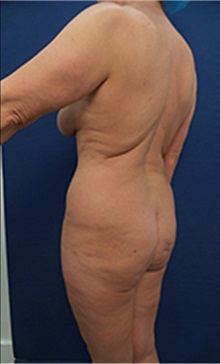 Buttock Lift with Augmentation Before Photo by Arian Mowlavi, MD; Laguna Beach, CA - Case 36564