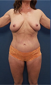 Buttock Lift with Augmentation After Photo by Arian Mowlavi, MD; Laguna Beach, CA - Case 36564