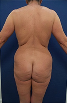 Liposuction Before Photo by Arian Mowlavi, MD; Laguna Beach, CA - Case 36565