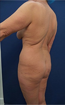 Liposuction Before Photo by Arian Mowlavi, MD; Laguna Beach, CA - Case 36565
