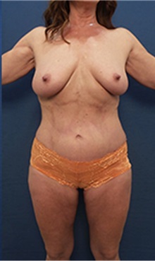 Tummy Tuck After Photo by Arian Mowlavi, MD; Laguna Beach, CA - Case 36566