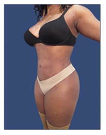 Liposuction After Photo by Arian Mowlavi, MD; Laguna Beach, CA - Case 42984
