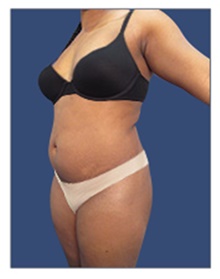 Liposuction Before Photo by Arian Mowlavi, MD; Laguna Beach, CA - Case 42984