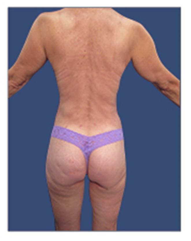 buttocks injections before and after photos