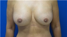Breast Augmentation After Photo by Rudolf Thompson, MD; Colts Neck, NJ - Case 30716