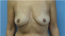 Breast Augmentation Before Photo by Rudolf Thompson, MD; Colts Neck, NJ - Case 30716
