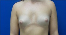 Breast Augmentation Before Photo by Rudolf Thompson, MD; Colts Neck, NJ - Case 30718