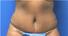 Tummy Tuck After Photo by Rudolf Thompson, MD; Colts Neck, NJ - Case 30726
