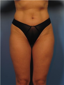 Body Contouring After Photo by Eric Mariotti, MD; Concord, CA - Case 40180