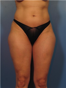 Body Contouring Before Photo by Eric Mariotti, MD; Concord, CA - Case 40180