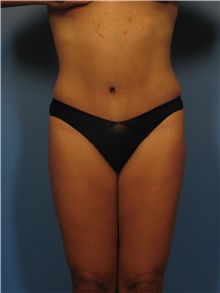 Body Contouring After Photo by Eric Mariotti, MD; Concord, CA - Case 40182