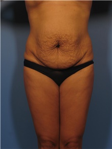 Body Contouring Before Photo by Eric Mariotti, MD; Concord, CA - Case 40182
