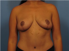 Body Contouring After Photo by Eric Mariotti, MD; Concord, CA - Case 40182
