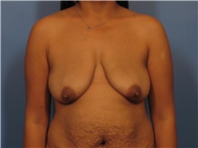 Body Contouring Before Photo by Eric Mariotti, MD; Concord, CA - Case 40182
